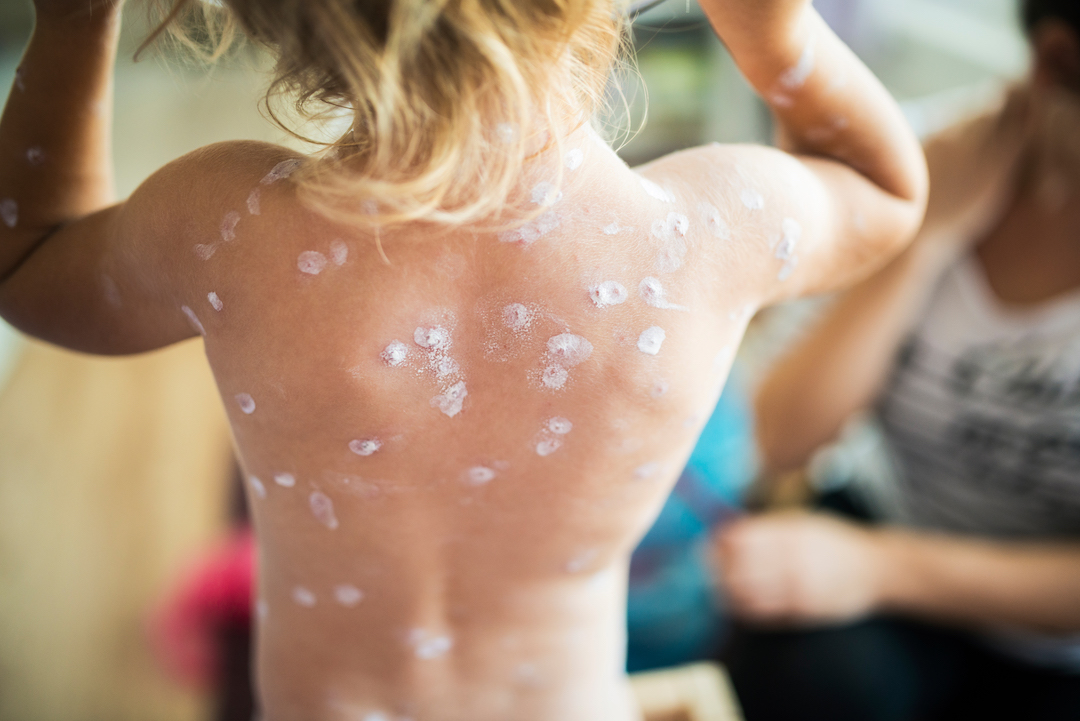 chickenpox vaccine coventry